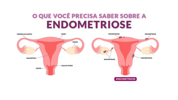A endometriose!